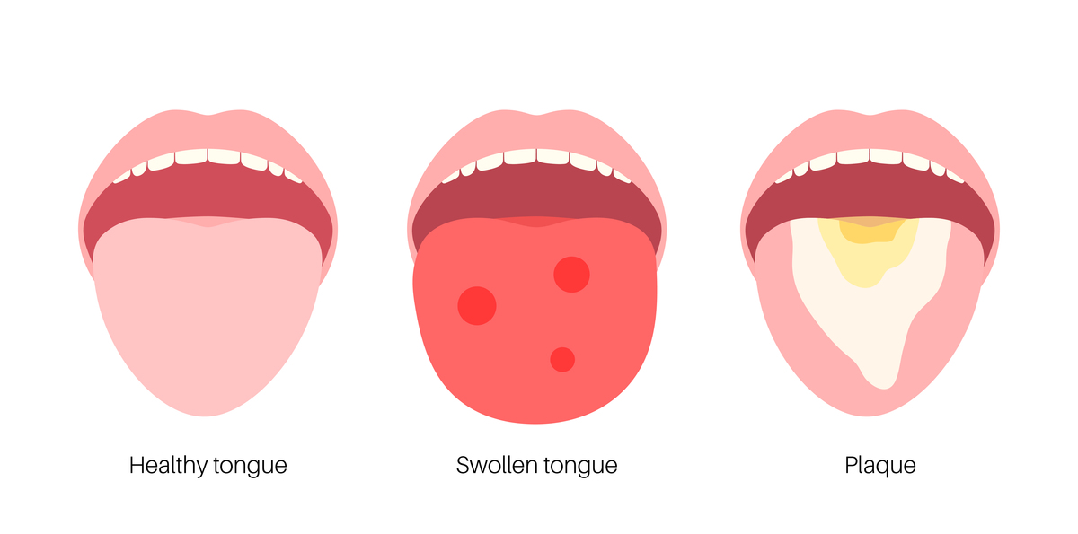 早上起床舌苔泛白是什么病