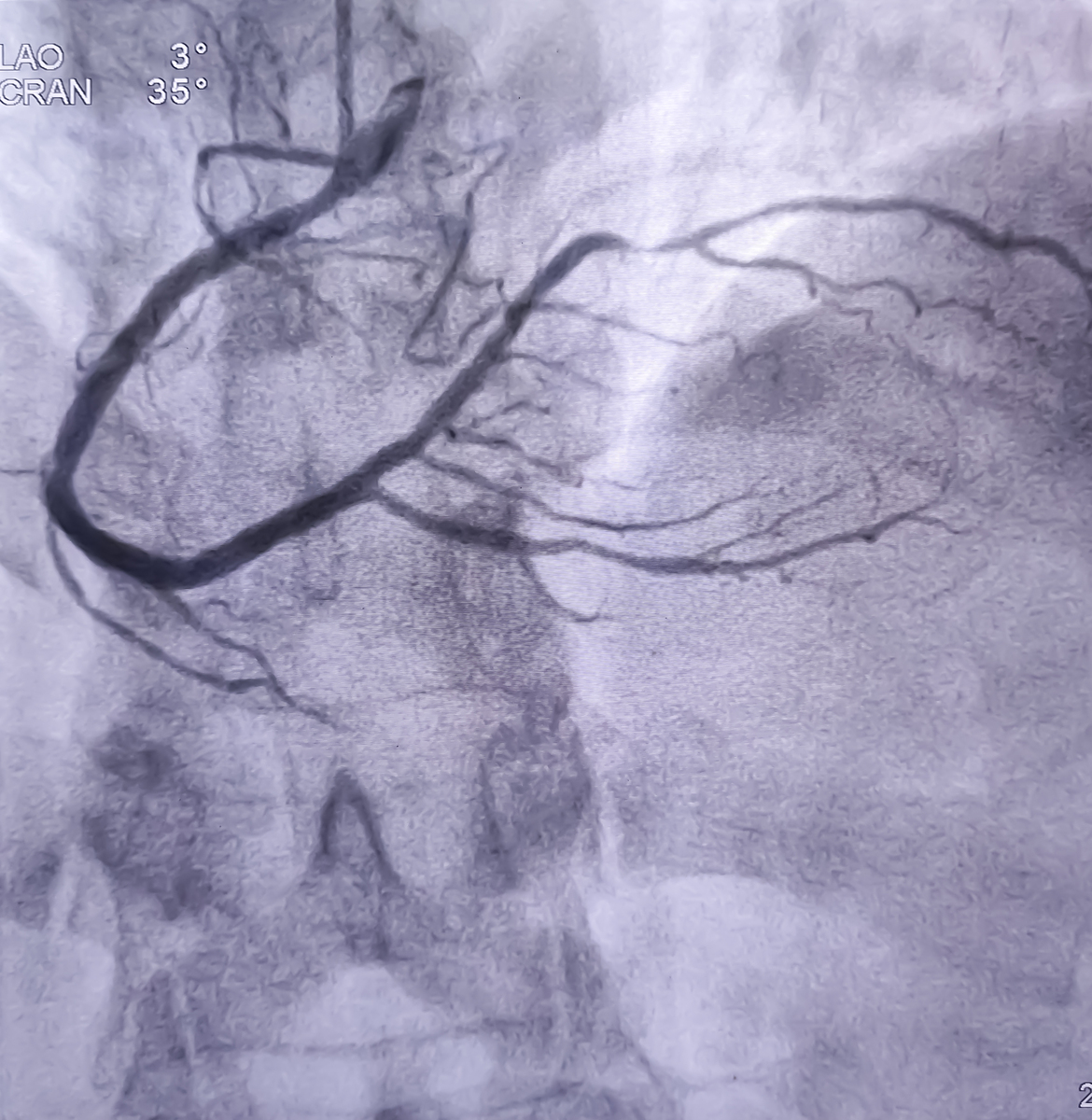 颈动脉超声造影：诊断疾病的便捷高效方法