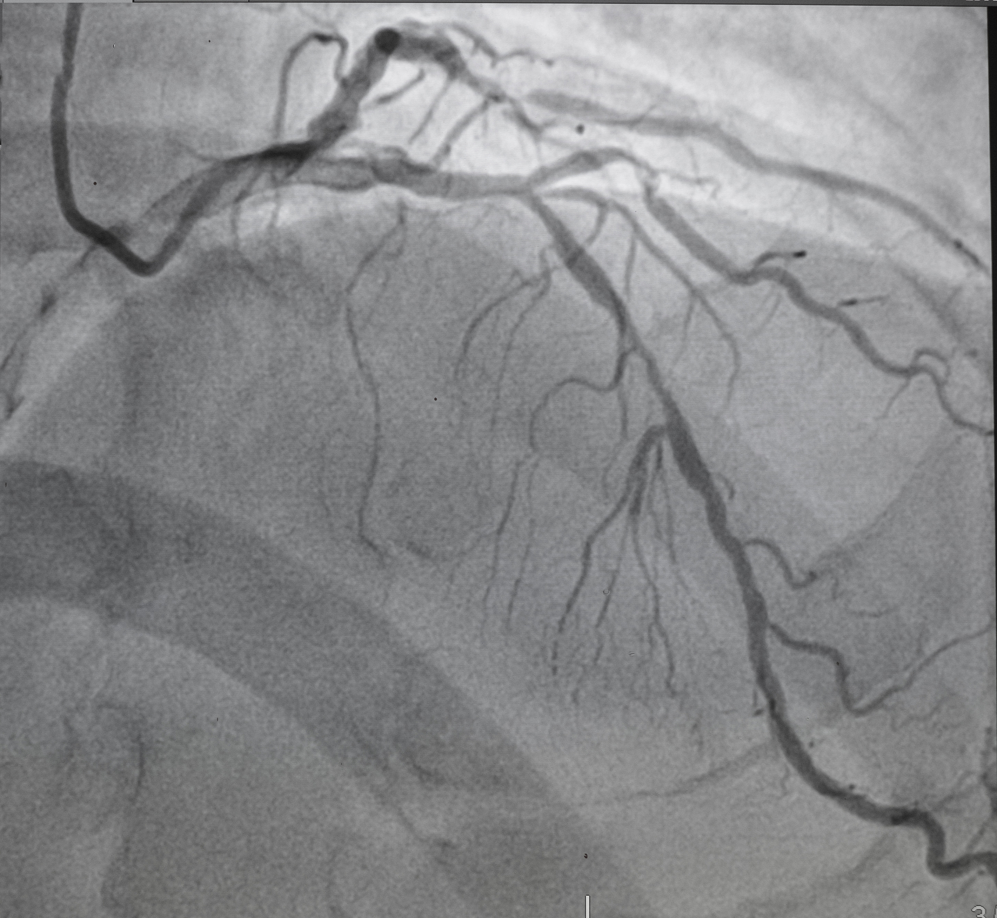 颈动脉易损斑块破裂：早期诊断至关重要，超声造影是首选方法