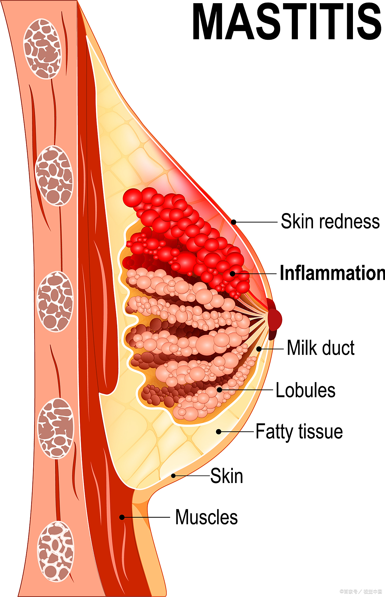 乳腺炎：了解病因、症状和治疗方法的综述