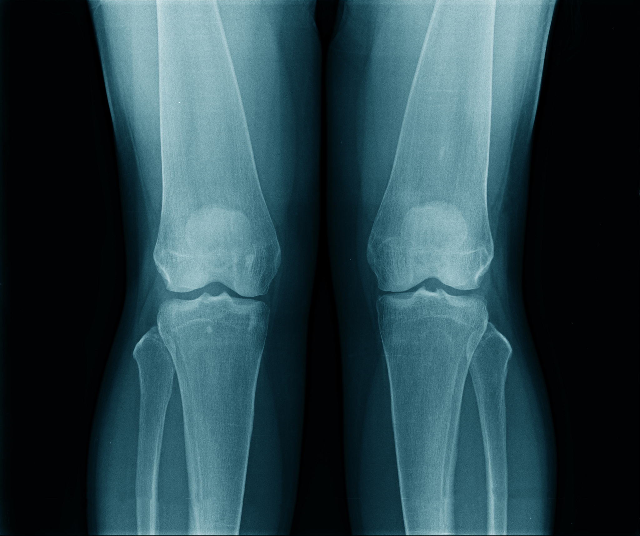 小腿骨连接大腿骨关节受伤有多痛？算轻伤吗？