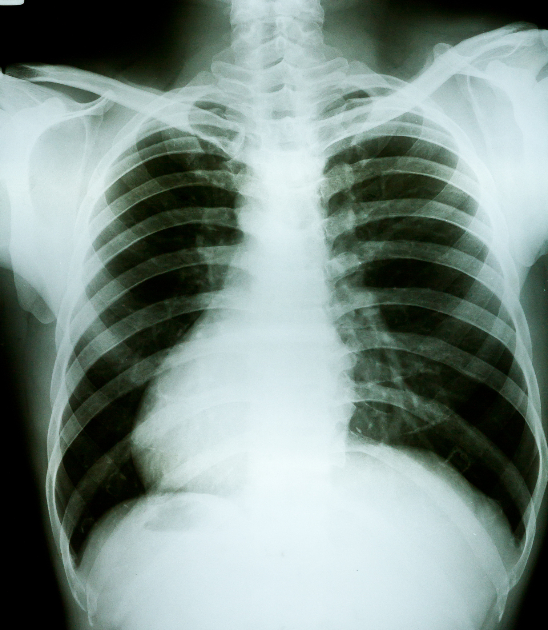 老年慢性阻塞性肺疾病患者肺部信息需求调查及影响因素分析