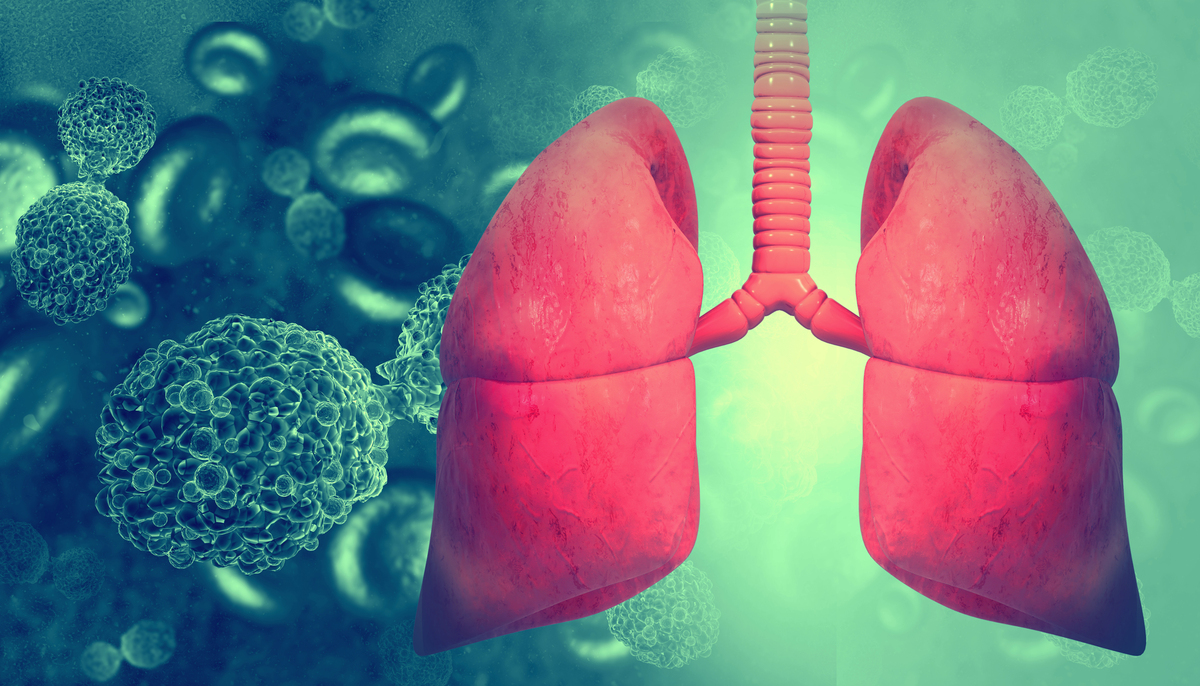 烟雾病：吸烟导致的肺部疾病