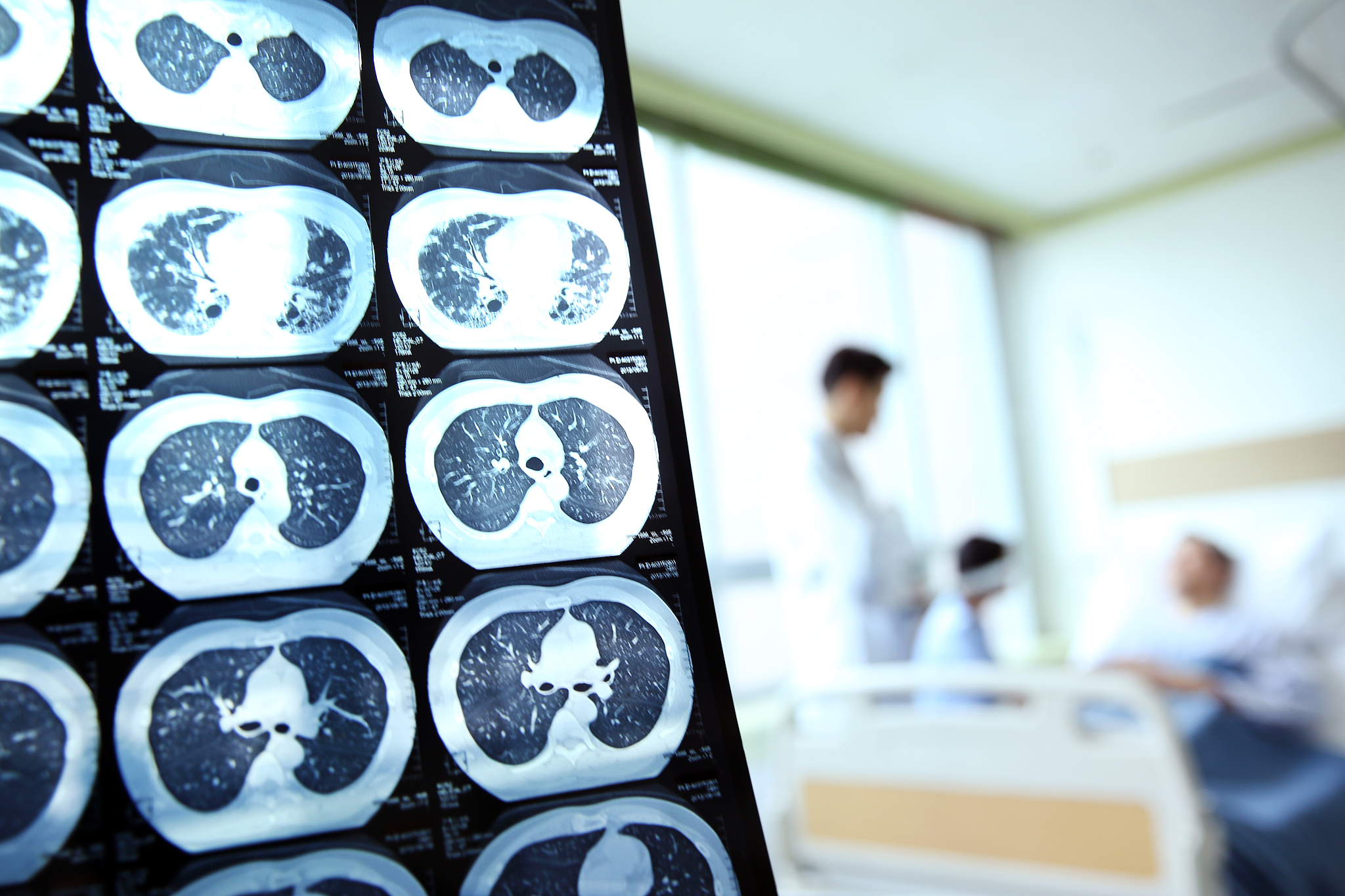 社区获得性肺炎CT影像鉴别诊断：肺栓塞、肺结核、肺癌