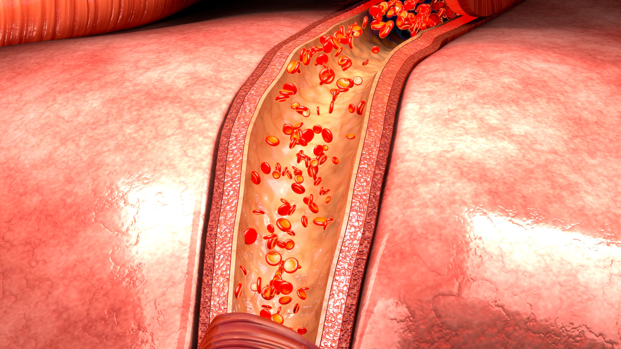 动脉自由漂浮血栓: 定义、风险和治疗