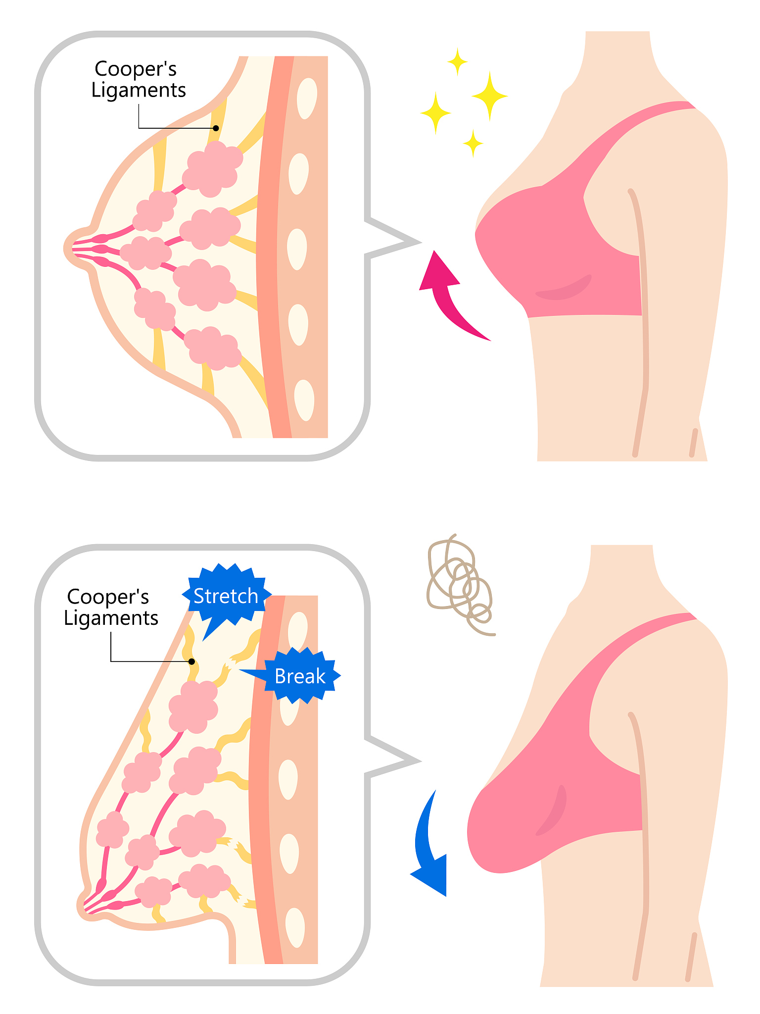 乳房大小不一怎么办？常见原因和解决方法