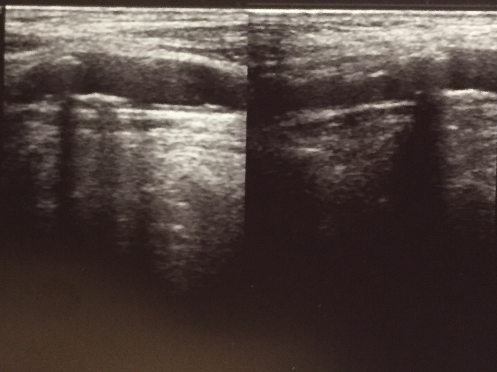 超声造影评估斑块易损性：研究揭示新血管形成与斑块增强程度的关系