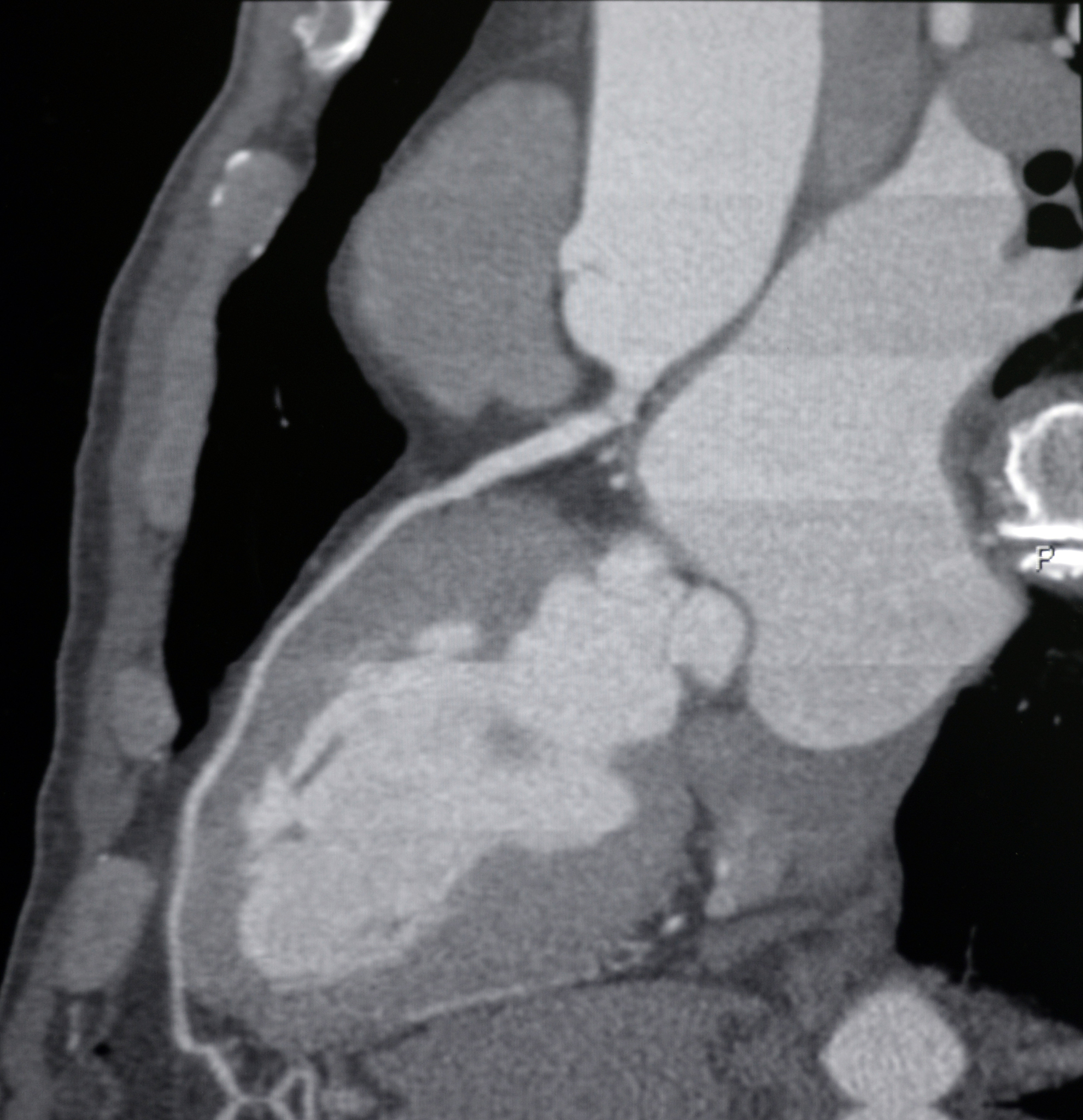 冠状动脉粥样硬化性心脏病患者护理中的问题
