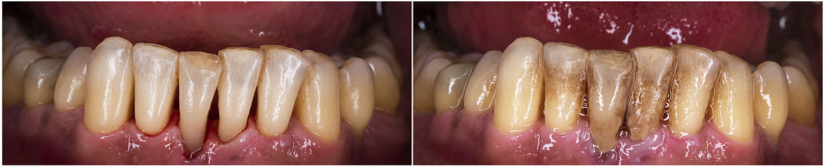 西安护理学校：美白牙齿的有效方法和实用医疗知识