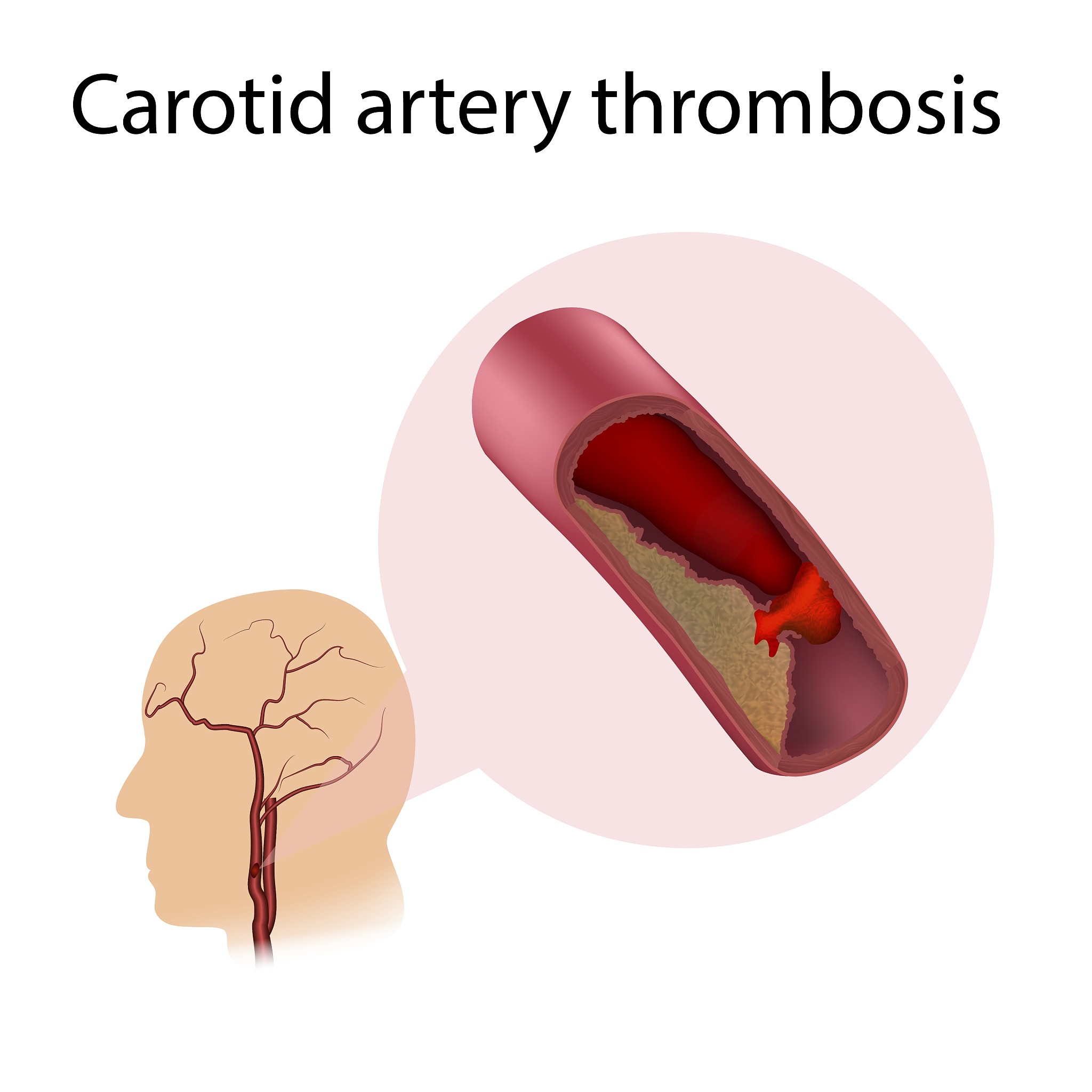 翻译：CEUS for diagnosis of free-floating thrombosis with stroke due to acute rupture of vulnerable plaque in the right carotid artery-A case report