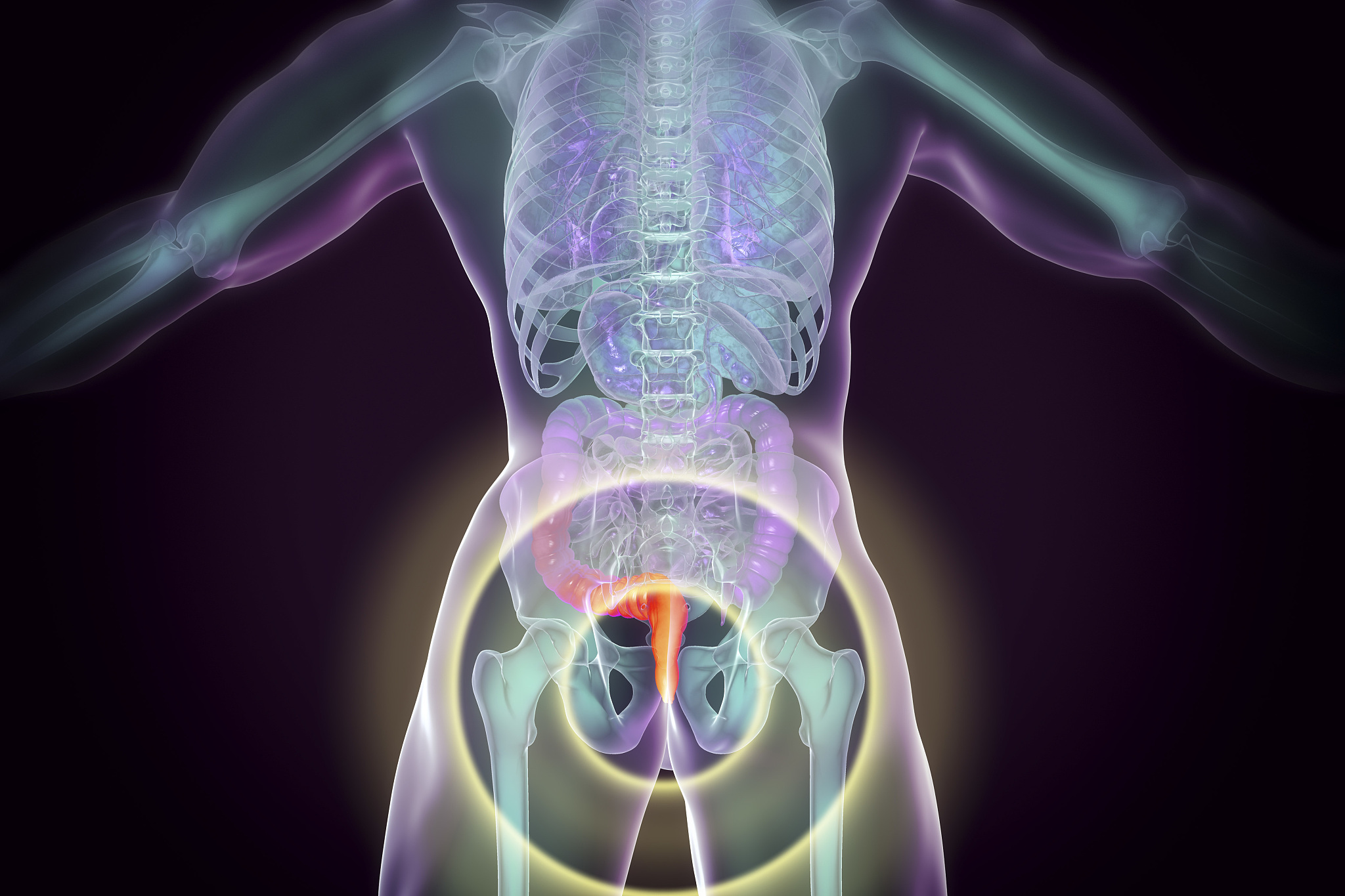 haemorrhoids, illustration