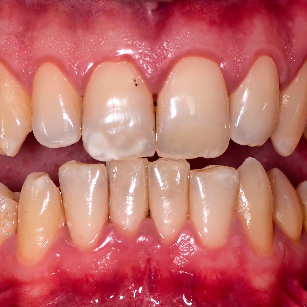 牙齿咬合疼痛的原因：医生解答常见问题