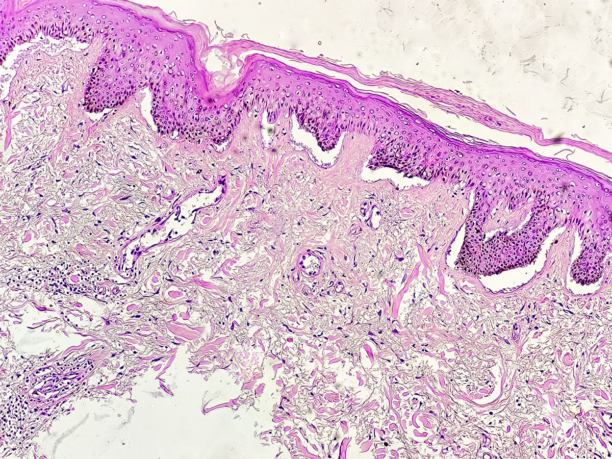 Dyna-CT Assisted Neuroendoscopic Hematoma Evacuation for Hypertensive Intracerebral Hemorrhage: Technical Features and Clinical Efficacy