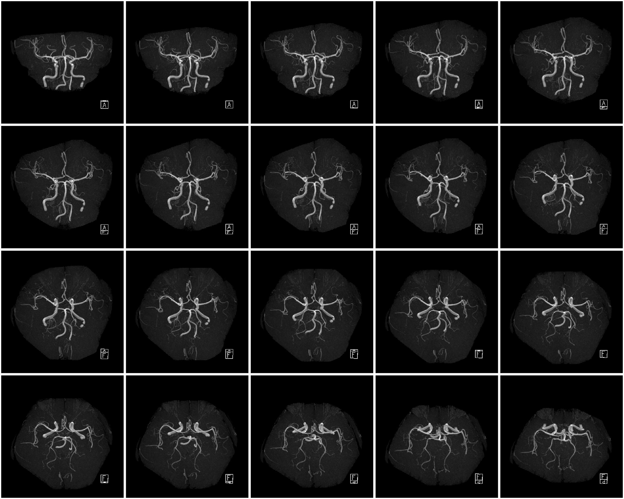 头影测量中的标志点Me点是