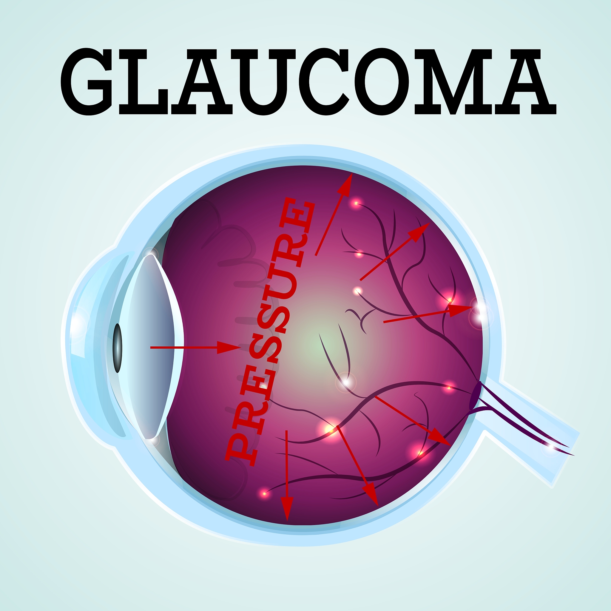 氟轻松玻璃体内植入剂治疗黄斑水肿