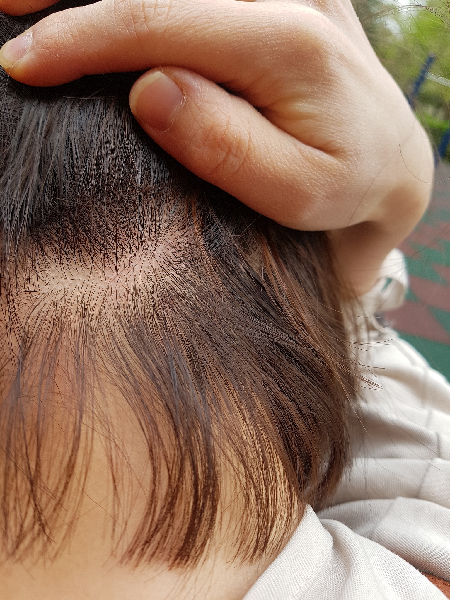 21岁女生一个月内快速恢复白发变黑？科学家的自然变黑秘诀！