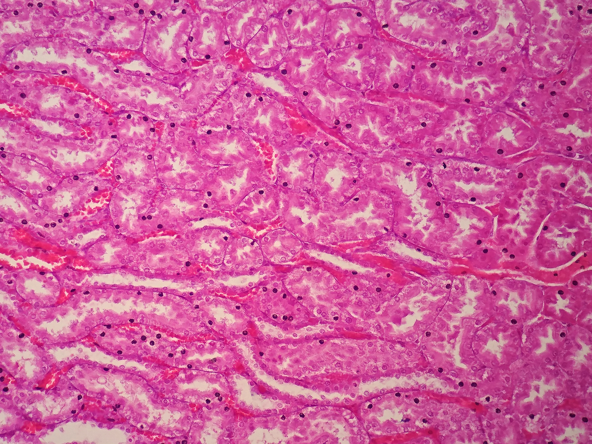 肾贫血性梗死镜下特点