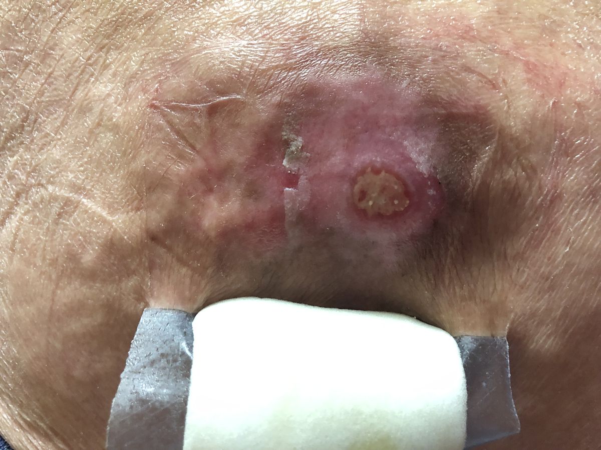 30、压疮分期错误的是 A、I期指压不变白的红斑	B、II期部分皮层皮损	C、III期全层皮损	D、IV期深度不明