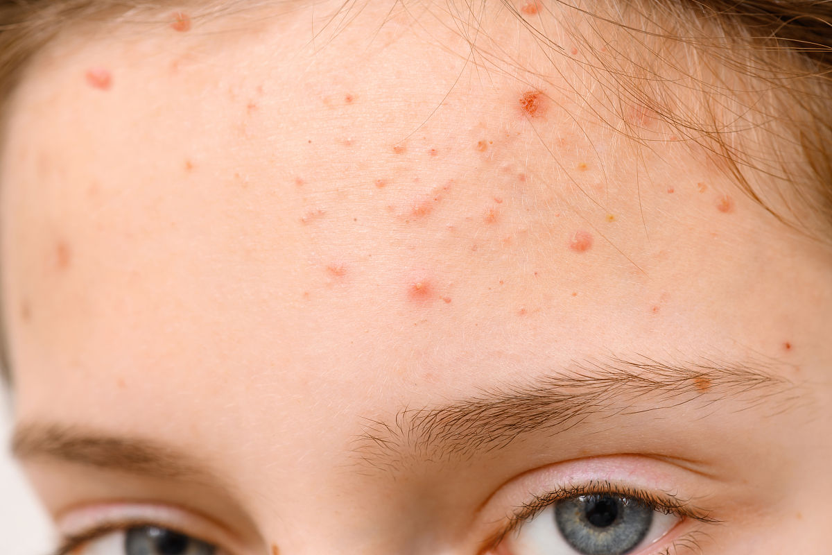 脸上长痤疮应该如何处理