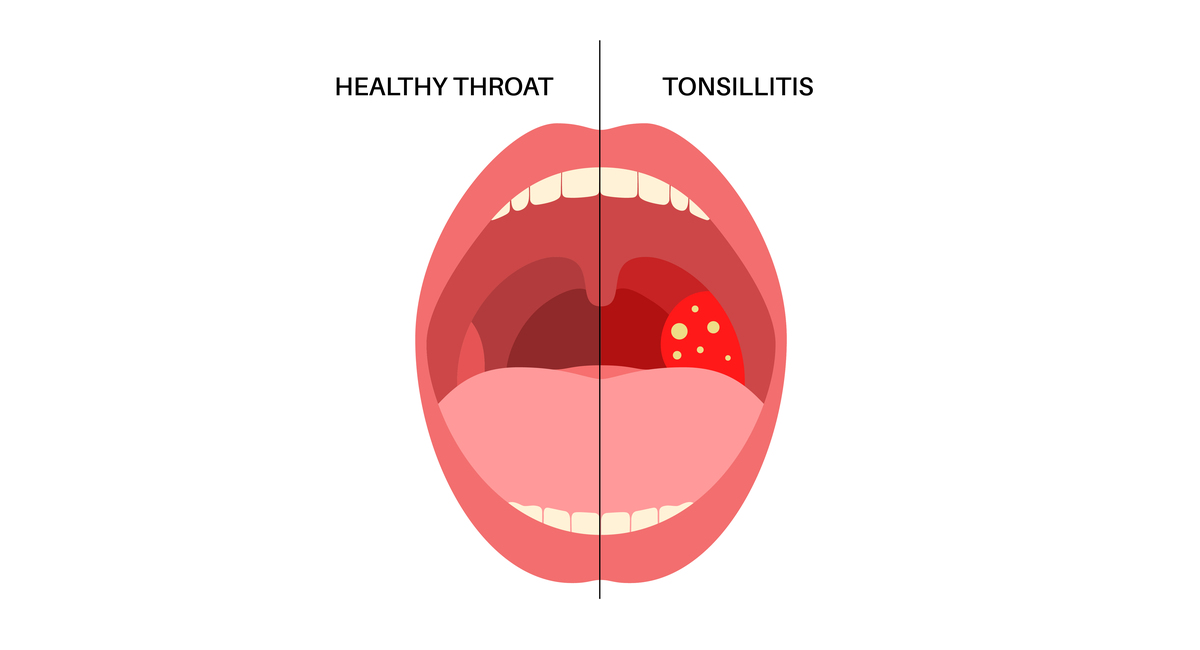 急性扁桃体炎并发症：观察、处理及预防