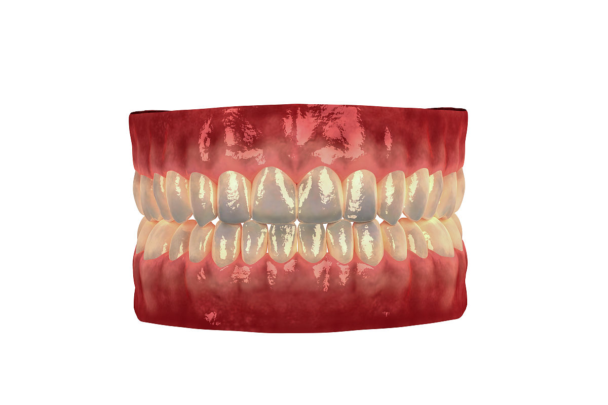 单颌牙列缺损：原因、影响及治疗方法