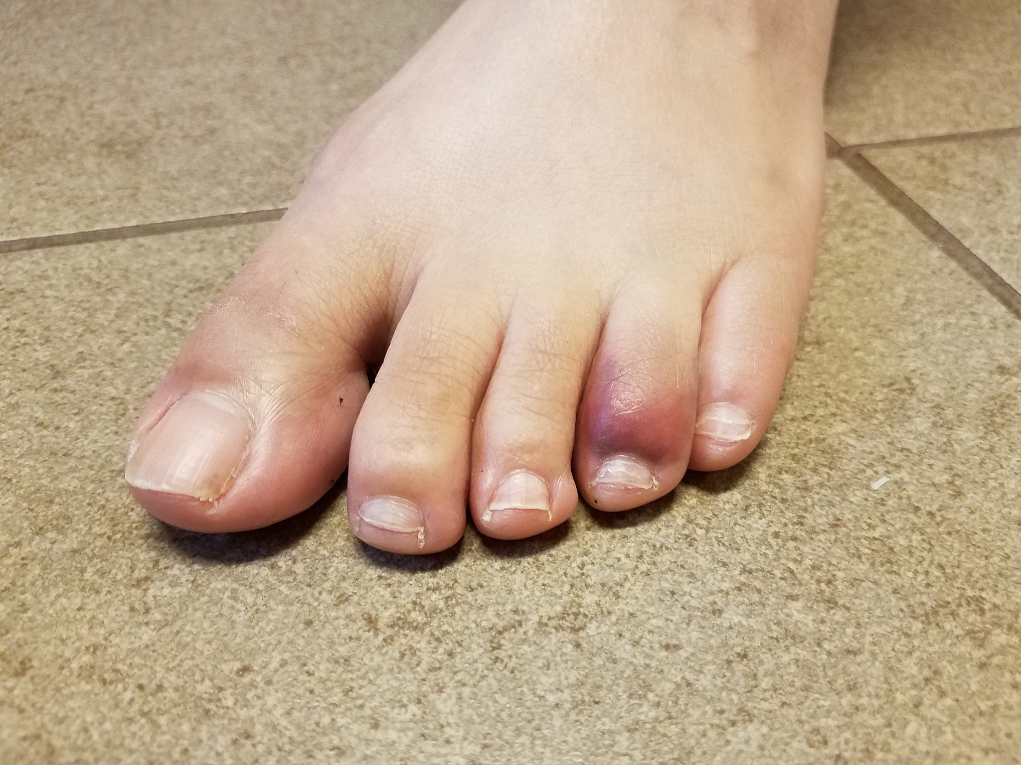 打球导致脚趾甲瘀血变黑怎么修复