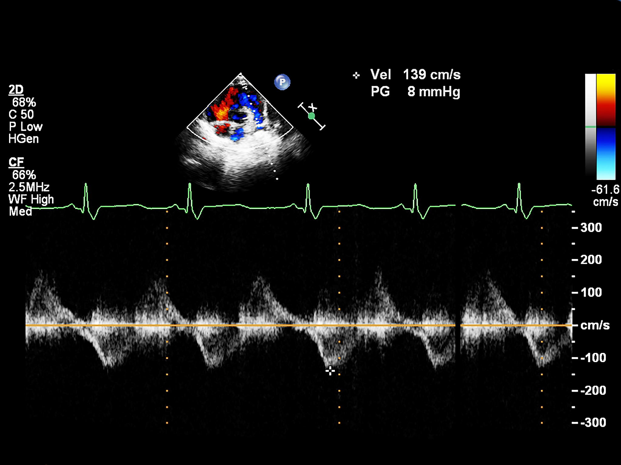 请改写下面的句子要求降重和同义词替换：中频信号的相位信息由雷达到人体中心距离和胸腔位移共同产生的相位构成其中R0部分产生的相位是常数相位。因此可以对前后相位作差去除常数相位部分得到与胸腔位移相关的相位并通过监测相位差的变化计算呼吸心跳的频率。