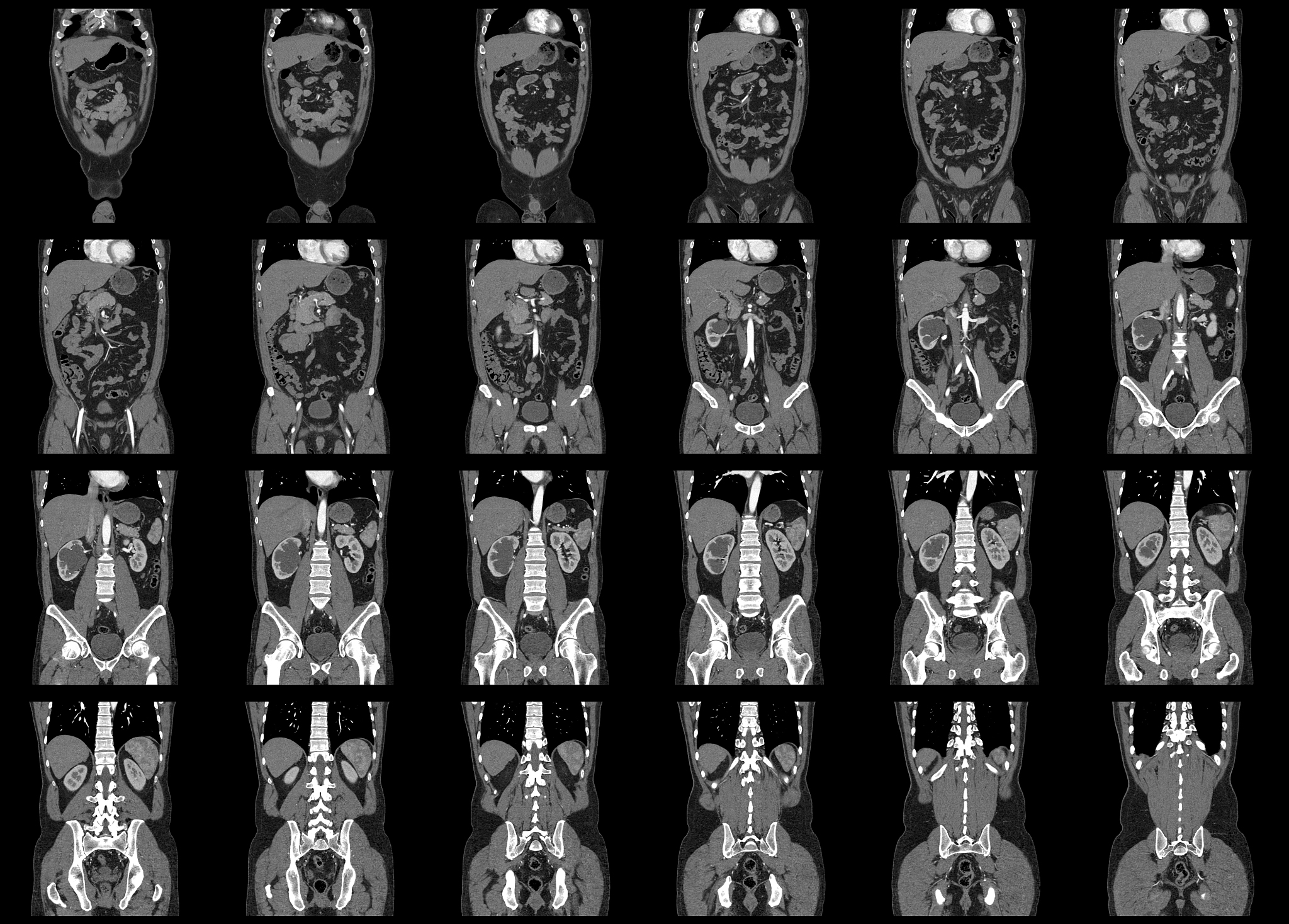 闭合性胸腹部损伤合并创伤性脾破裂