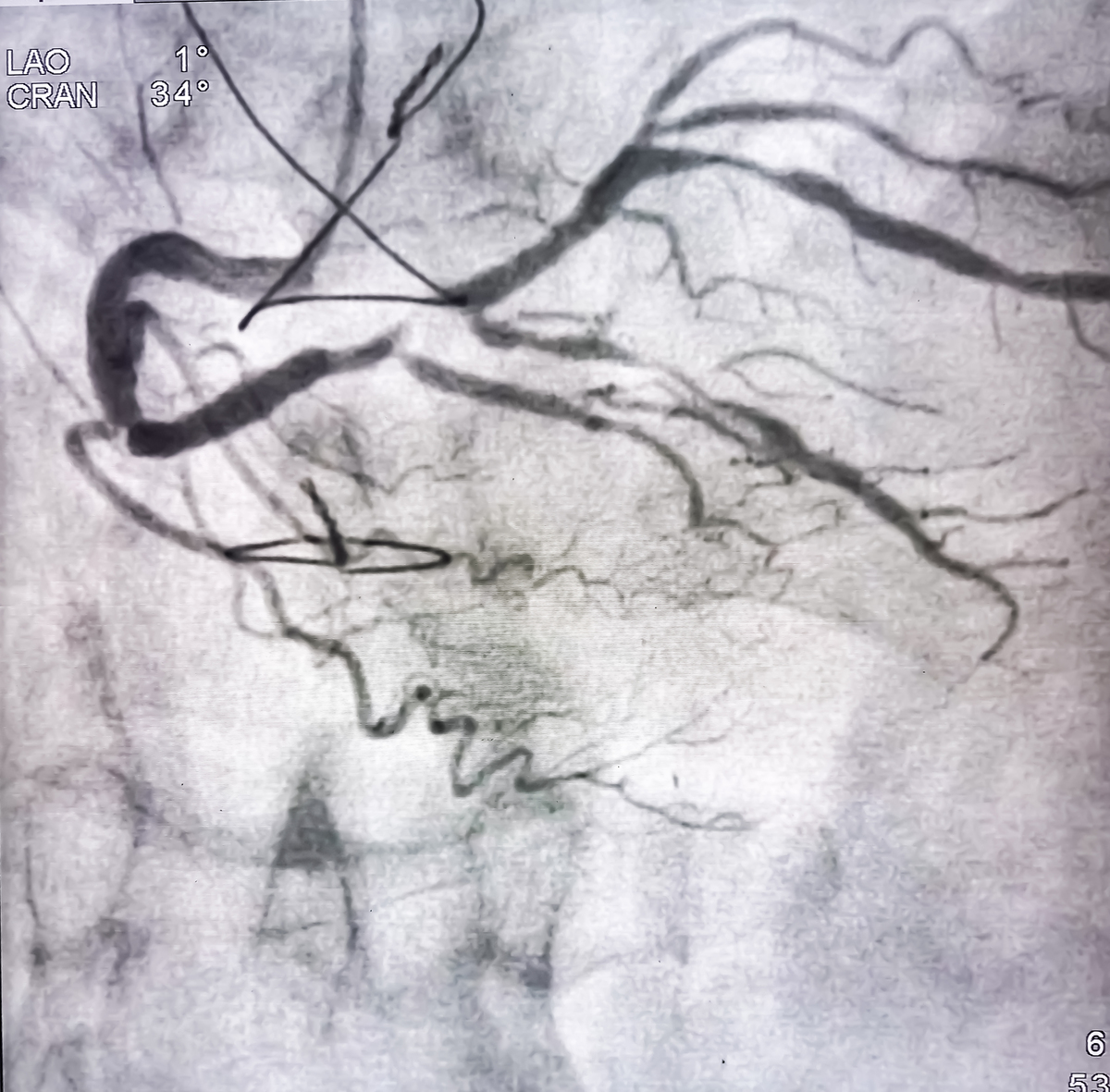 颈动脉易损性斑块破裂导致脑卒中：超声造影揭示全过程