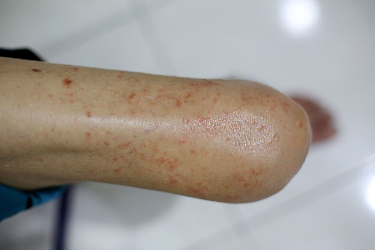 胳膊上有白色小点,痒!是湿疹吗? - 皮膚病症分析 胳膊上有白色小点,痒!是湿疹吗? - 皮膚病症分析