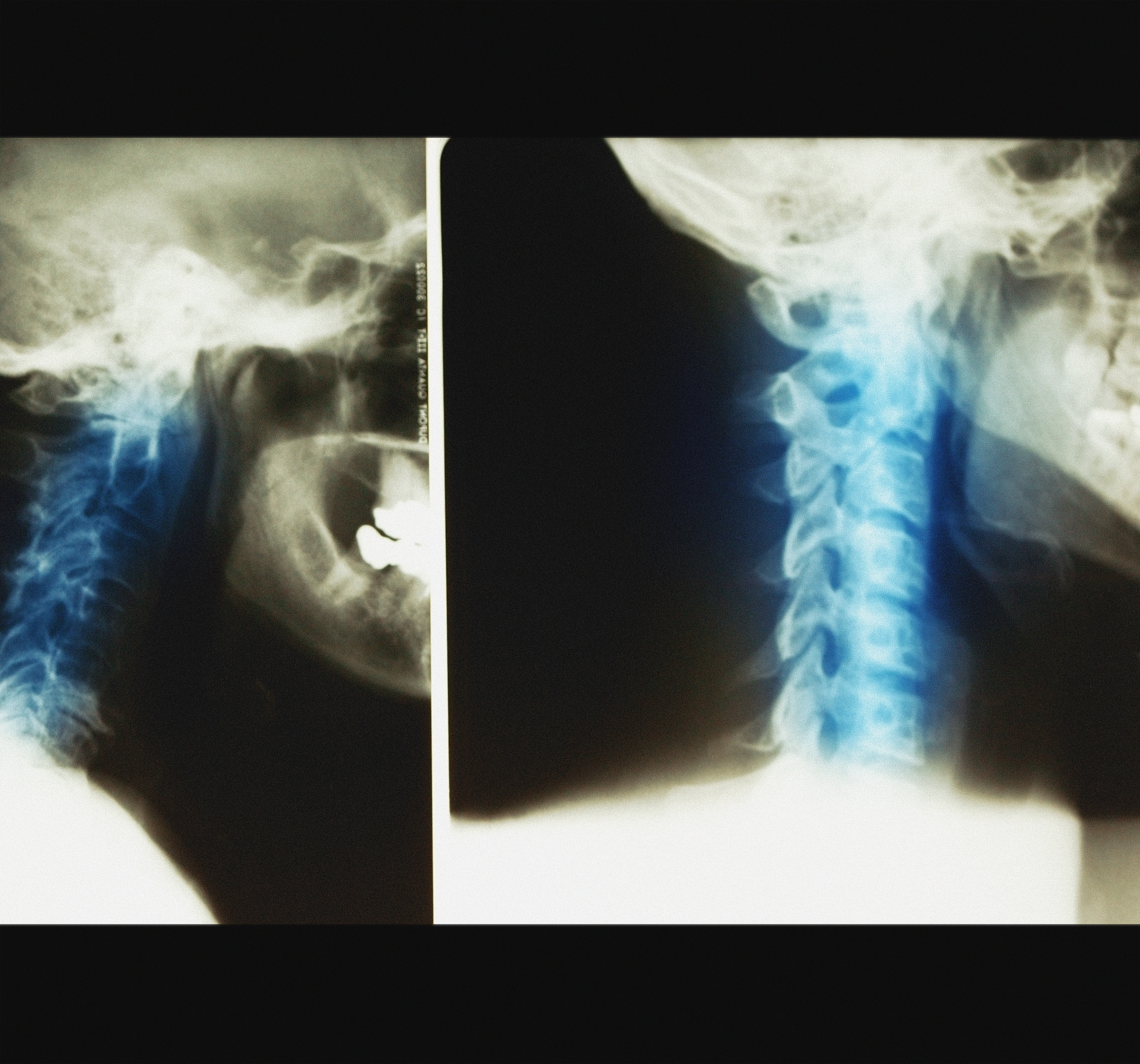 过山车后脖子酸痛？原因和应对方法