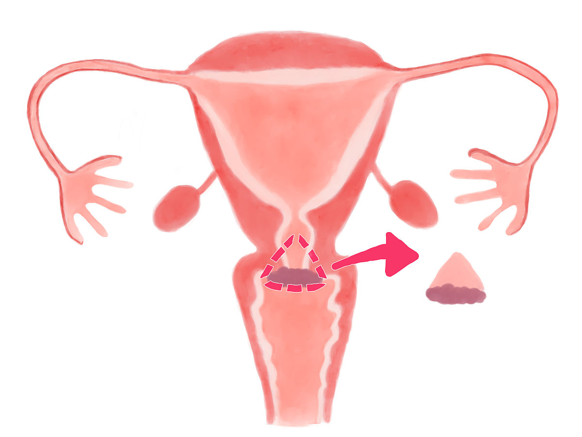 女性绝经后有出现流血。从这样的症状说明了什么问题？
