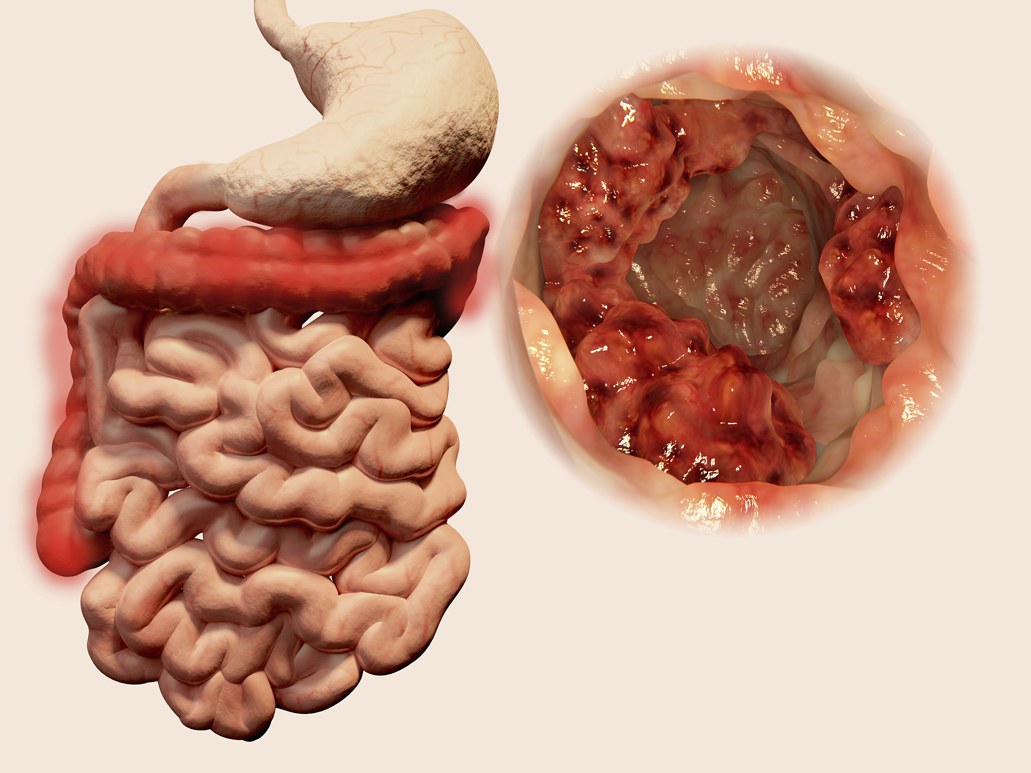 乙状结肠管状腺瘤的危害：出血、肠梗阻、癌变！