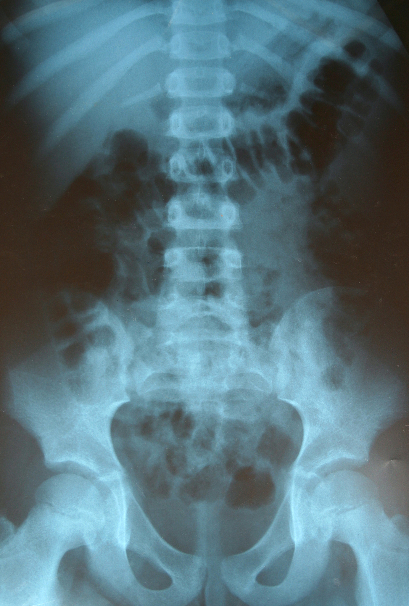 骨质疏松症osteoporosis是一种以骨量低下、骨组织微结构损坏导致骨脆性增加易发生骨折为特征的全身性骨病。而骨质疏松性骨折或称脆性骨折是指受到轻微创伤相当于从站立高度或更低的高度跌倒即发生的骨折是骨质疏松症的严重后果。骨质疏松性骨折的常见部位包括椎体、前臂远端、髋部、肱骨近端和骨盆等。而研究表明男性的骨质疏松性骨折的发生率及骨质疏松性骨折性死亡率更高。骨骼的完整性是由不断重复、时空偶联的骨吸