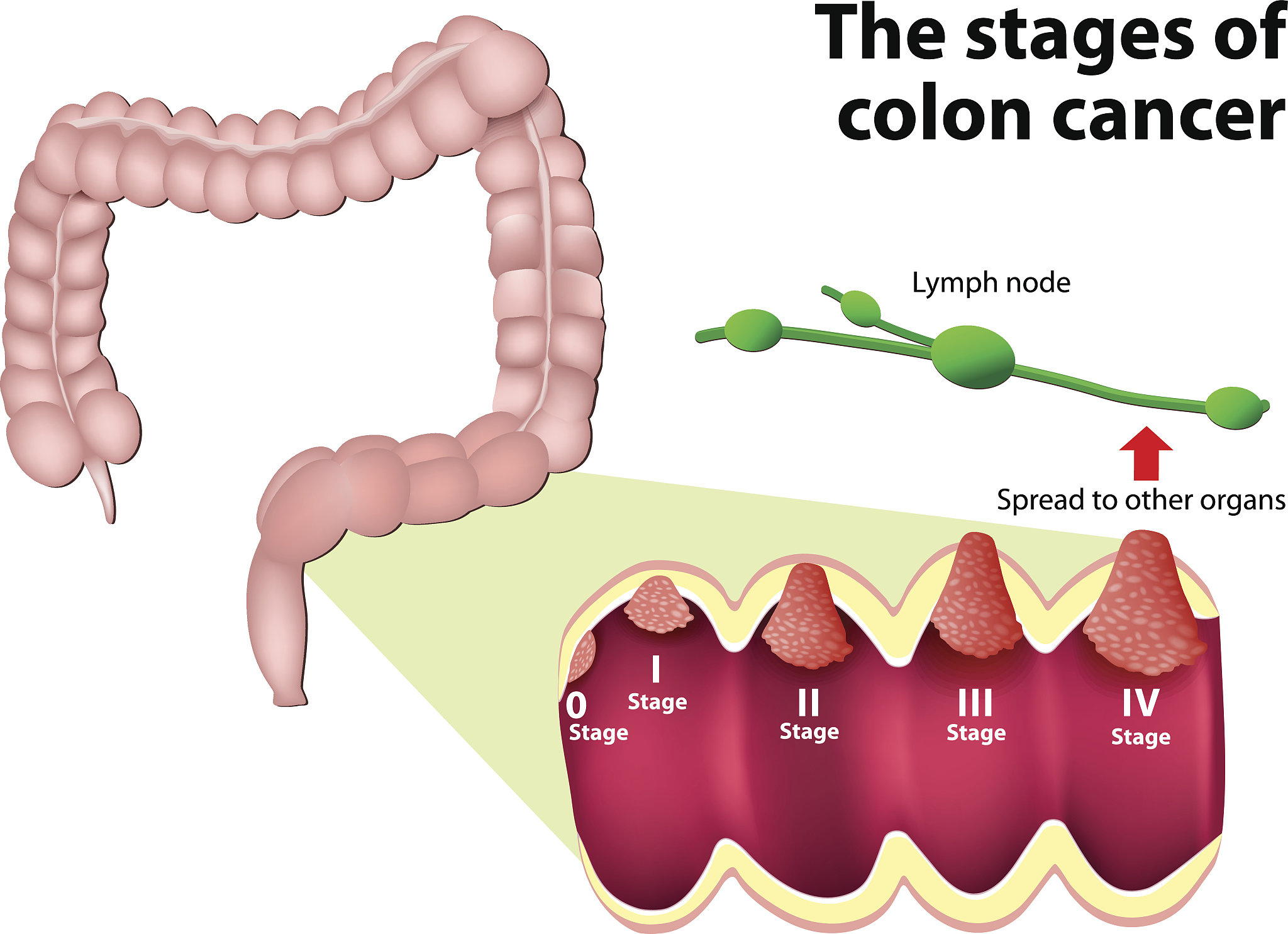 brief summary：结直肠癌肝转移的流行病学结直肠癌Colorectal cancerCRC在中国是一种高发且发病率上升最快的消化道恶性肿瘤之一我国2015年结直肠癌新发病例376万人占全部癌症88死亡191万占全部癌症死亡68从2000年至2015年间年均发病人数增加87严重威胁国人的生命健康1。结直肠癌具有早期发现治疗效果好外科切除可获得治愈机会。然而远处转移是结直肠癌致死的主要原因之