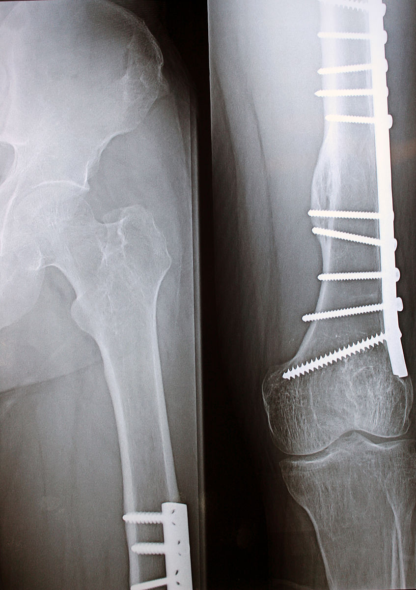 AO内固定 vs 外固定：哪个更适合你？