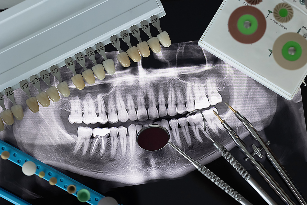生物陶瓷类材料单尖法根管充填术：国内外现状及应用