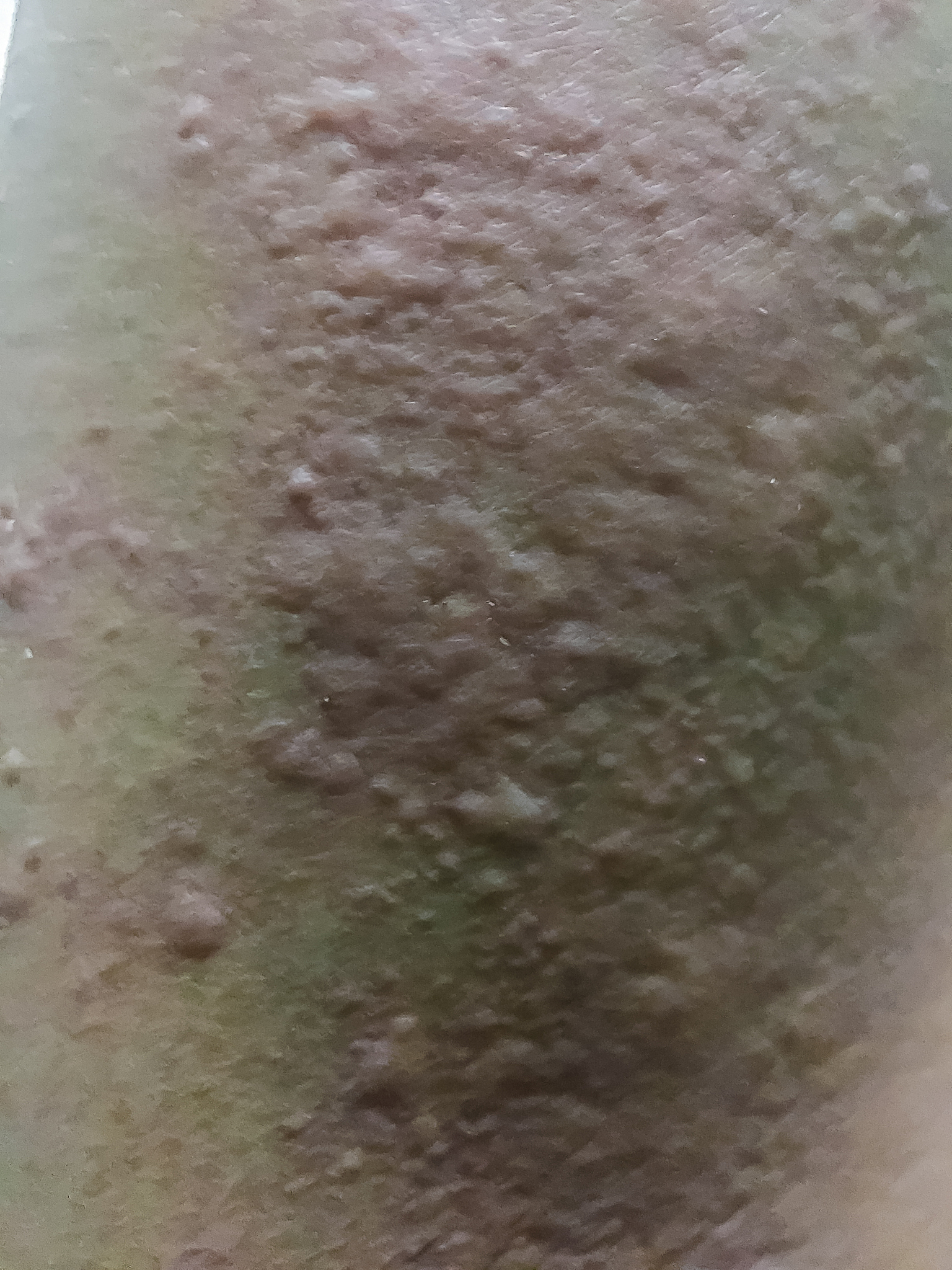 close up view of cold urticaria allergic rash. symptoms of itchy