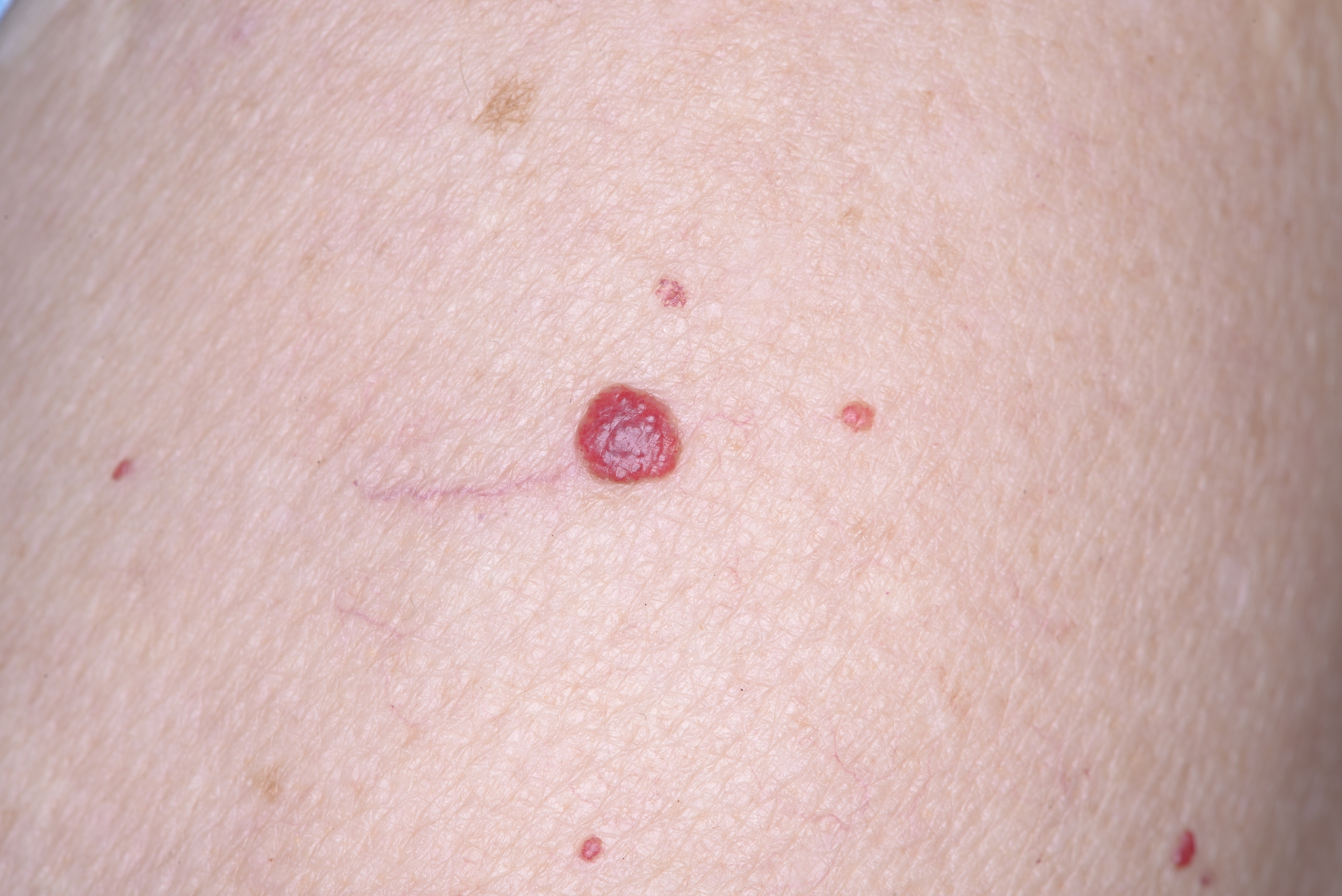 angioma