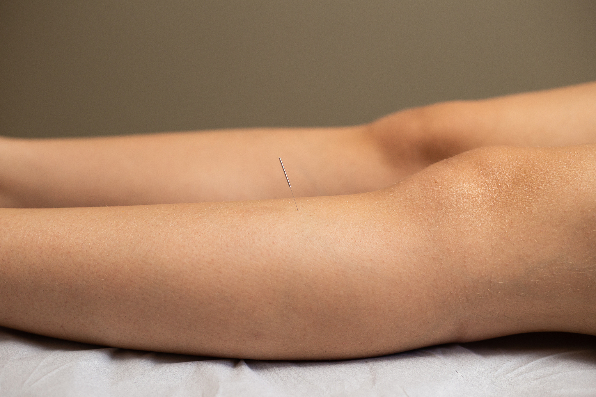 acupuncture.