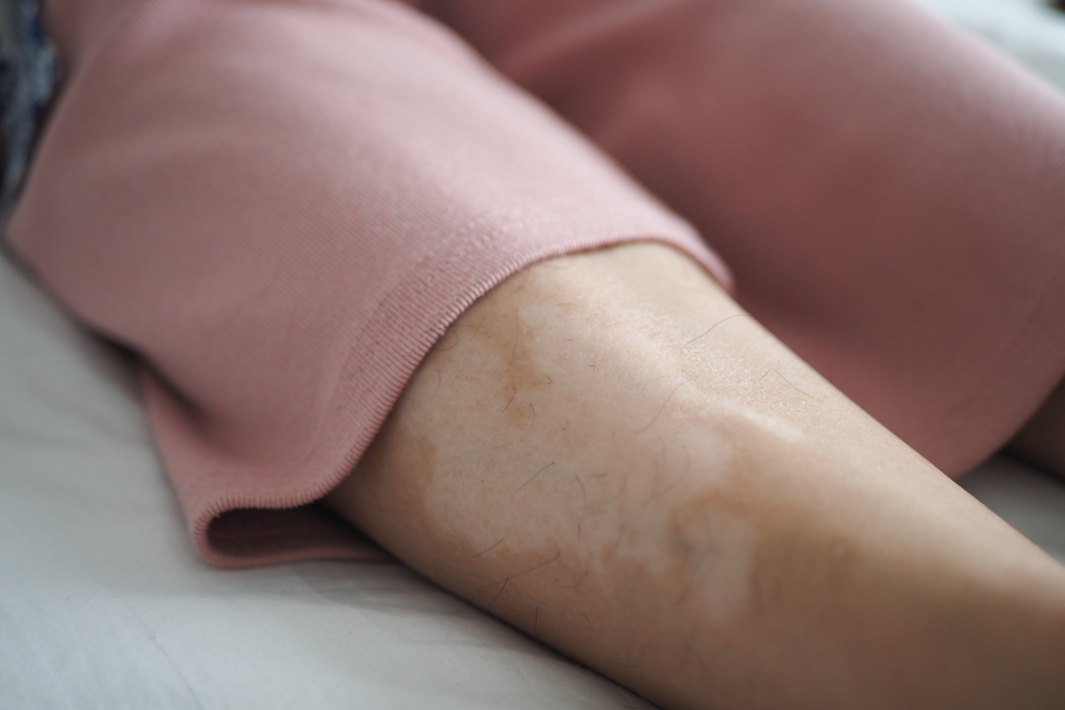 皮肤发白症状图片女生