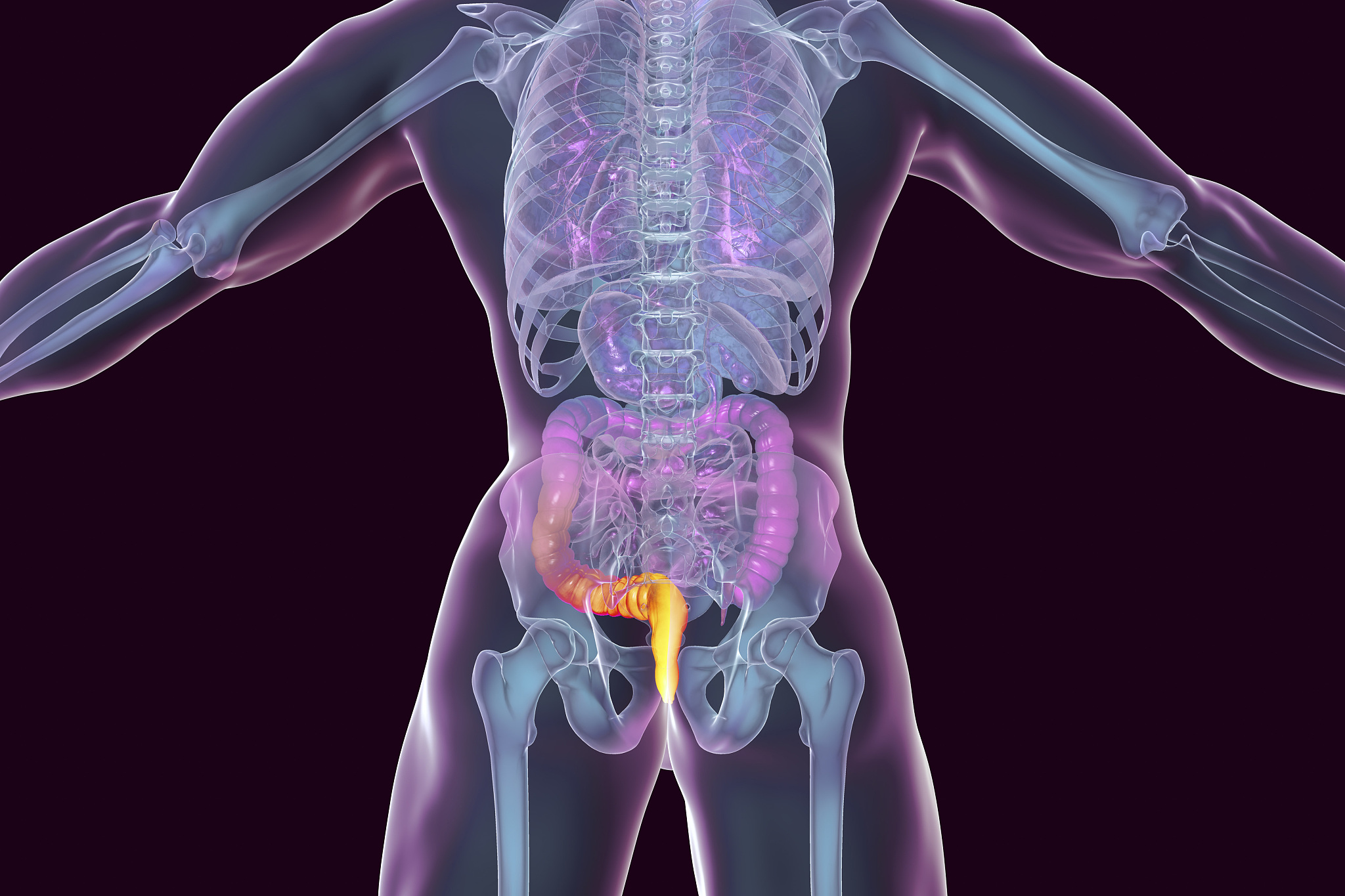 haemorrhoids, illustration