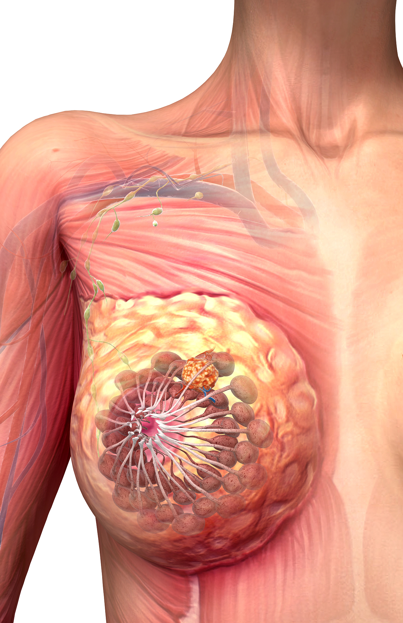早期乳腺癌患者腋窝淋巴结清扫：1-2枚前哨淋巴结转移的治疗选择
