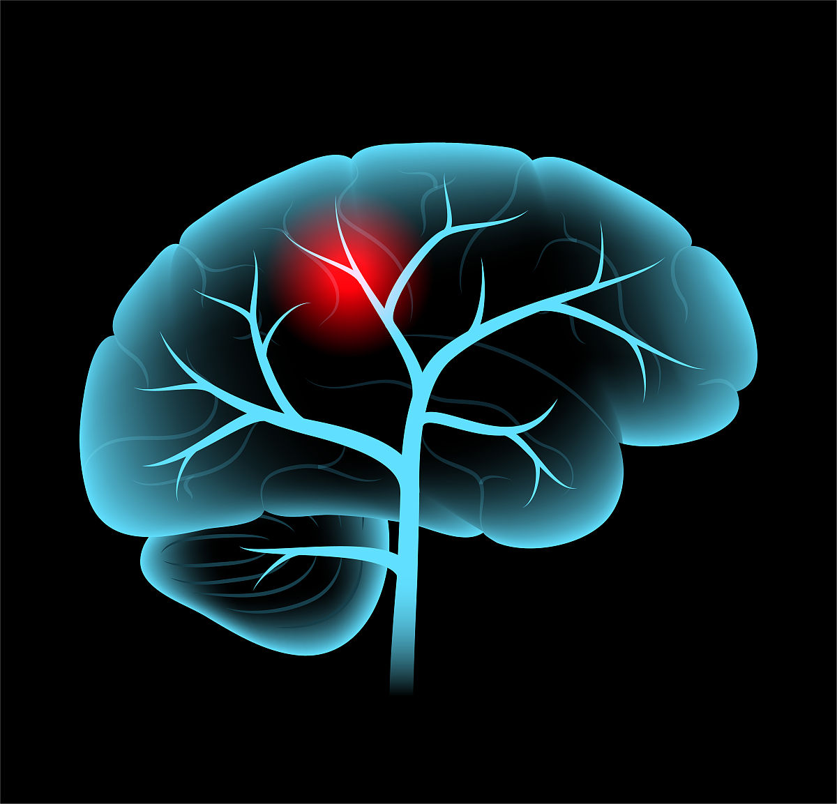 急性ST段抬高型心肌梗死伴高血压病3级：体征监控护理要点