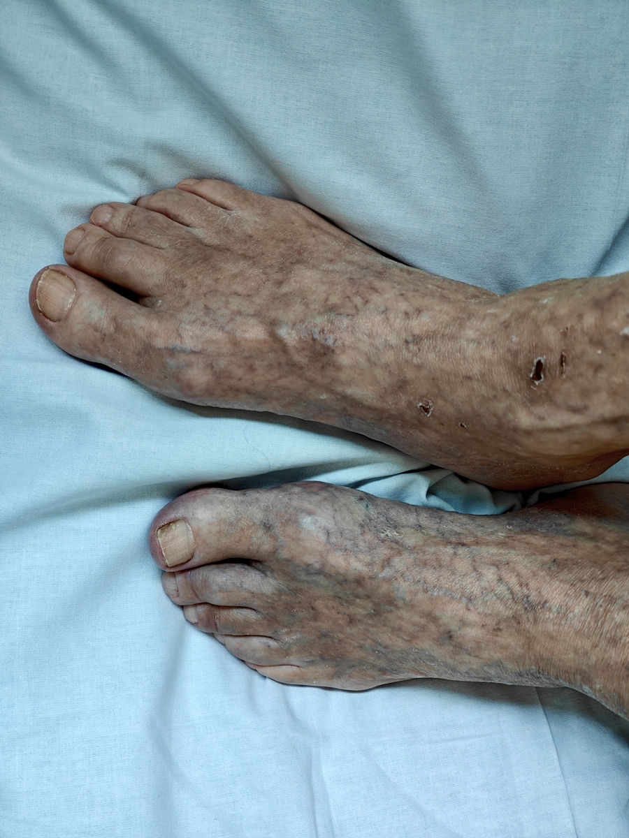 老年人脚肿是什么原因？有什么危害？