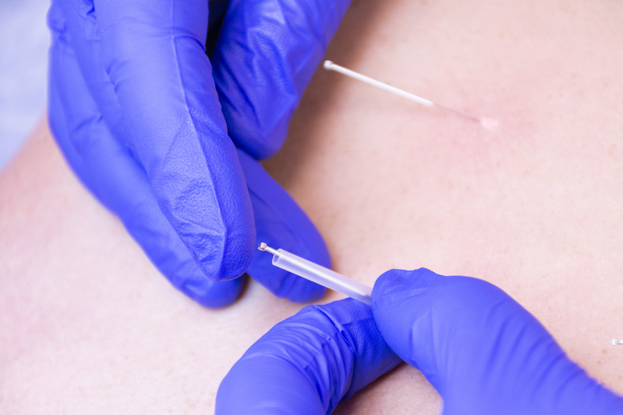 nailing an acupuncture needle