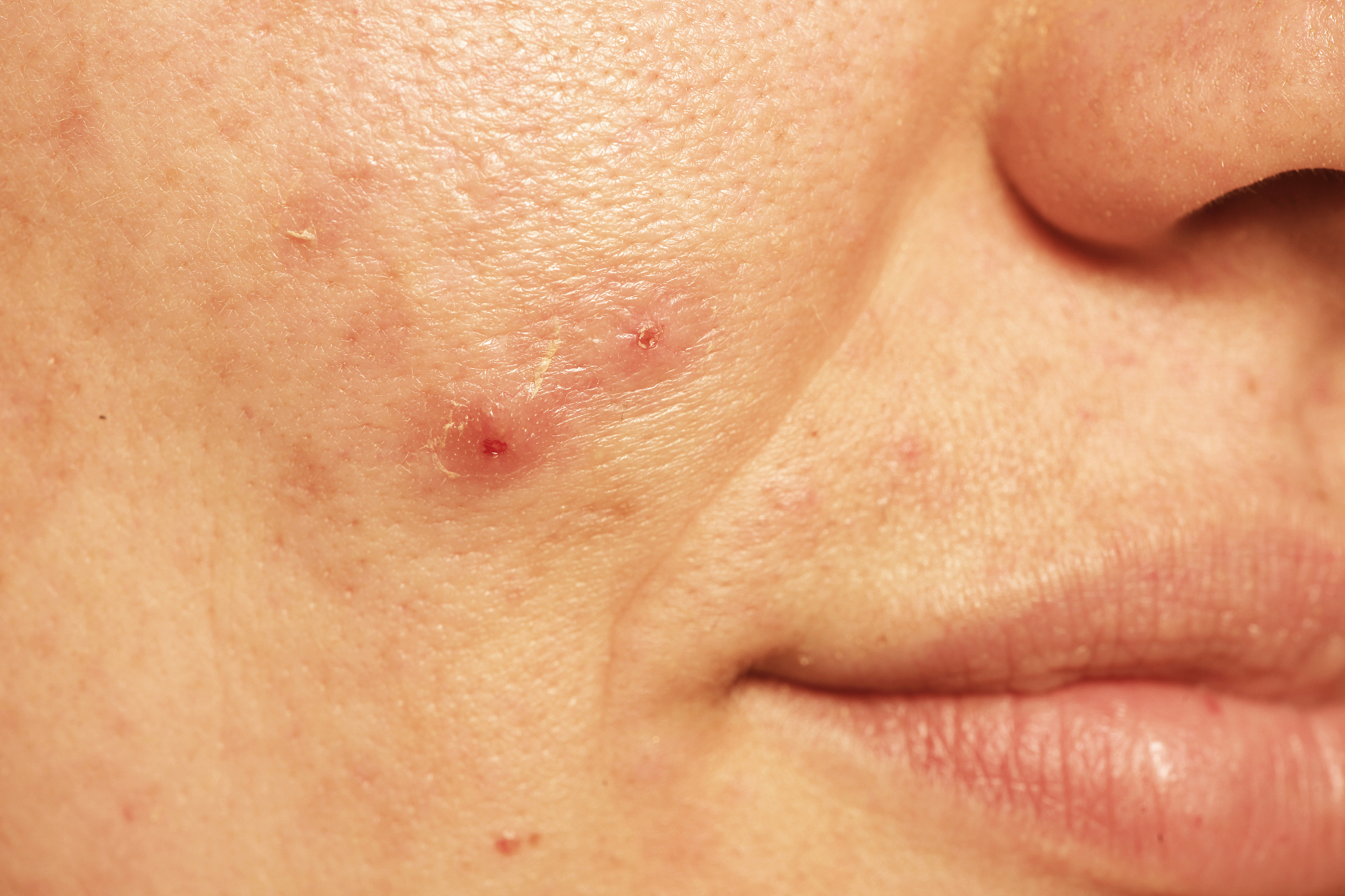 脸上硬块挤出来是血