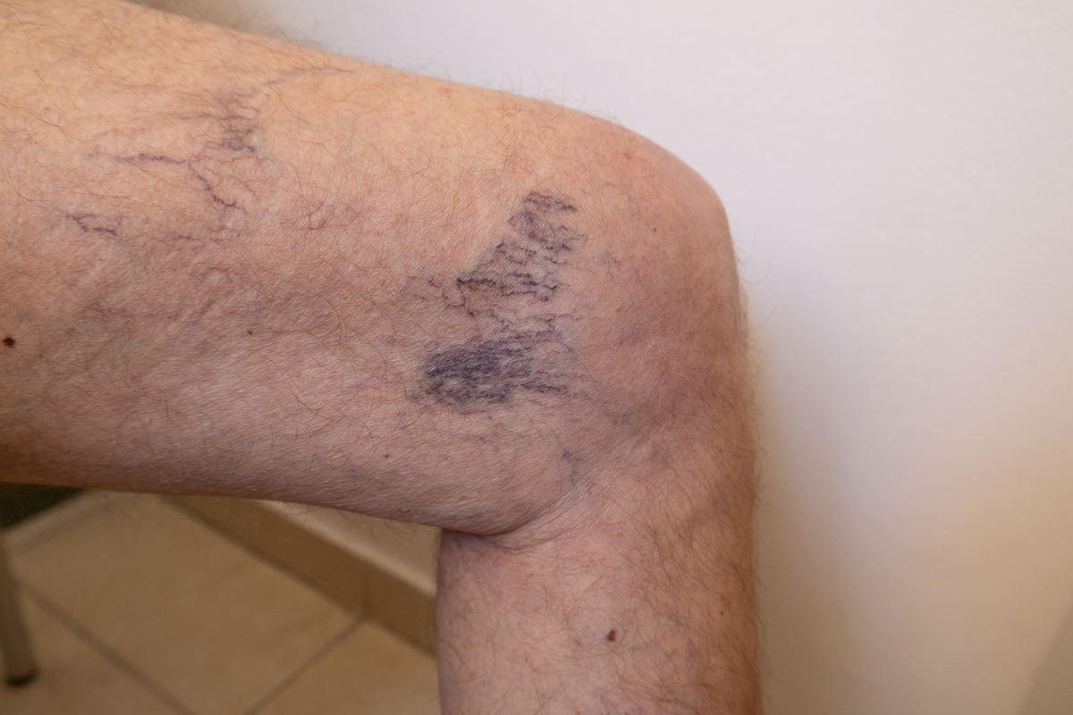 静脉曲张不手术的后果：轻则皮疹，重则危及生命！