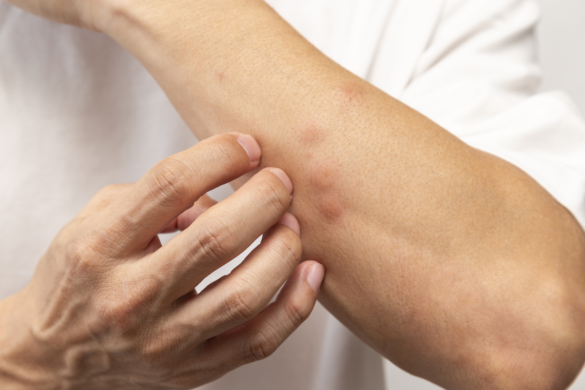 浑身发痒 并没有蚊子咬是什么情况