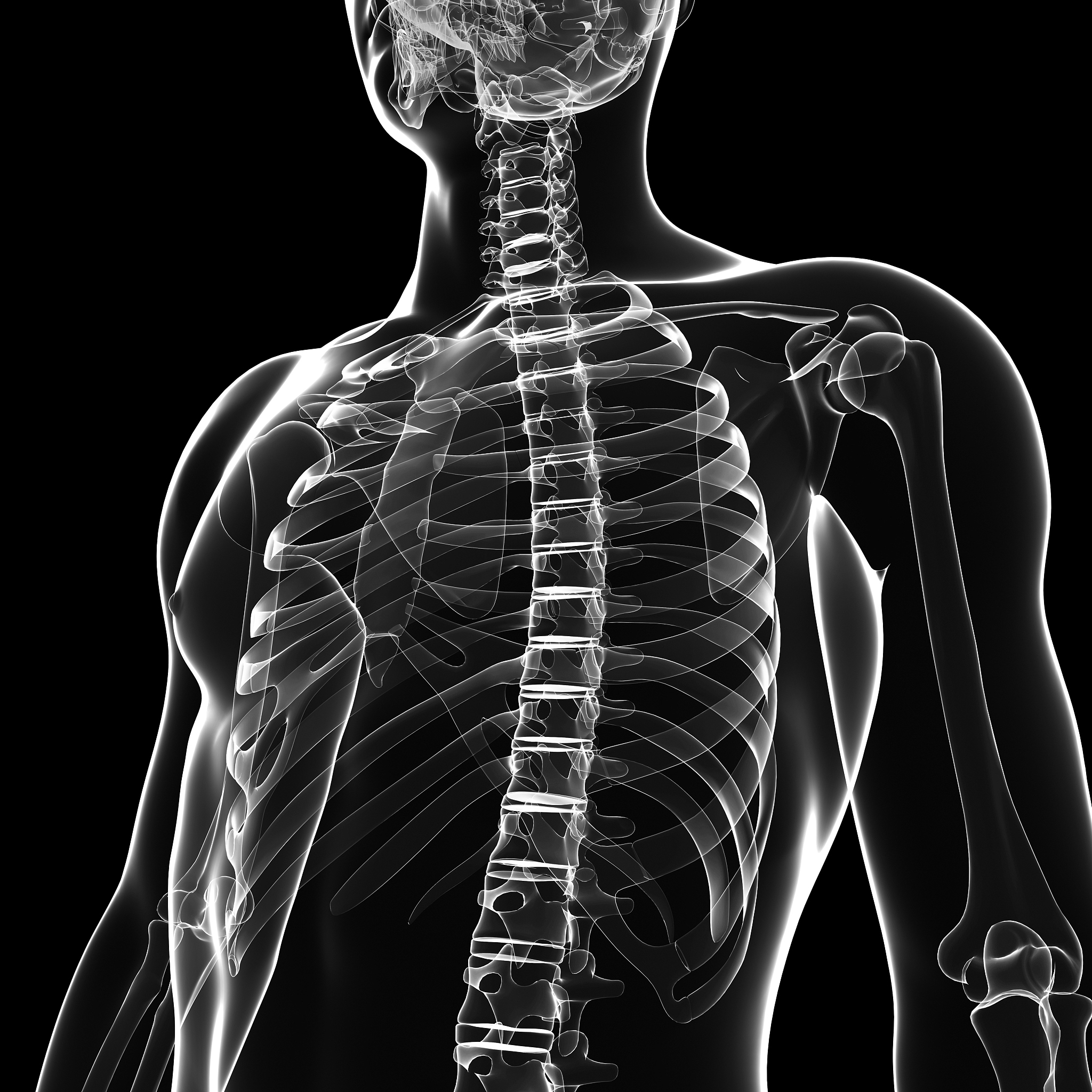 对以下内容进行润色：相较于正常成年人强直性脊柱炎患者的胸椎后凸增大、腰椎前凸减小、骨盆后倾更大而SVA、TK、PT、LL、SS则是影响其生活质量的相关因素。此外SVA、TK、PT的增大以及LL、SS的减小也会对强直性脊柱炎患者的生活质量产生负面影响。为了恢复患者理想的脊柱骨盆矢状面形态临床医师需要综合考虑患者相关测量参数并在手术过程中进行全面矫正以提高患者的术后生活质量。